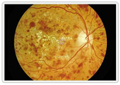 Diabetic Retinopathy - LUMERA - The Power of Vision | A Division of Axa